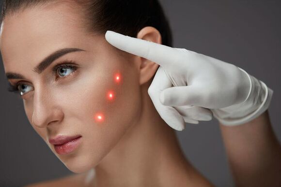 Facial skin rejuvenation by laser