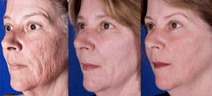 Results after laser facial rejuvenation