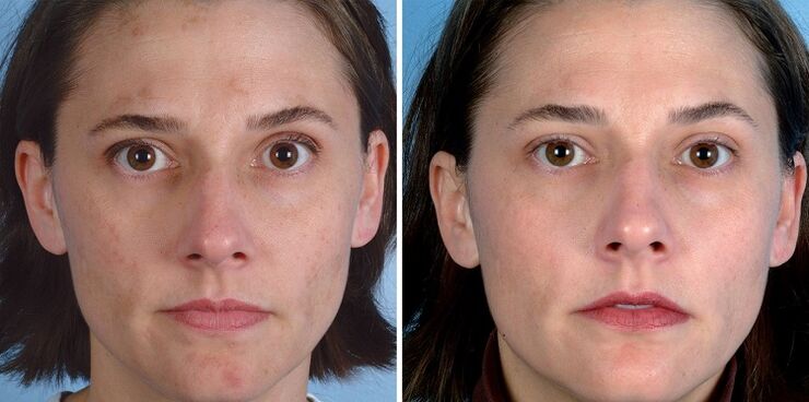 before and after skin rejuvenation by device