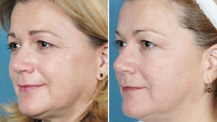 photo before and after hardware skin rejuvenation
