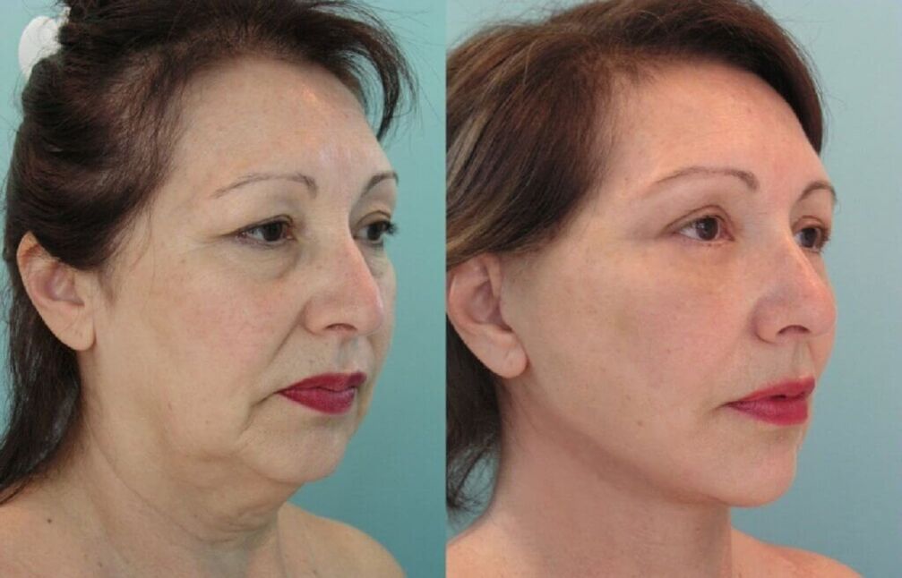 before and after photos of skin rejuvenation